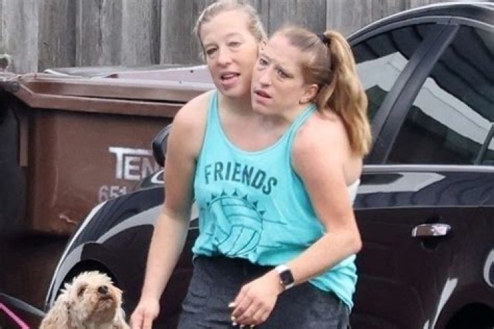 Abby and brittany hensel separation qlerowatches