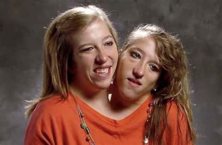 Conjoined Twins Abby and Brittany's Exciting News! Trendy Matter