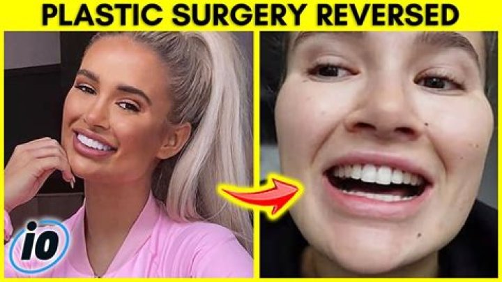 Haley Layne Plastic Surgery Complete Details