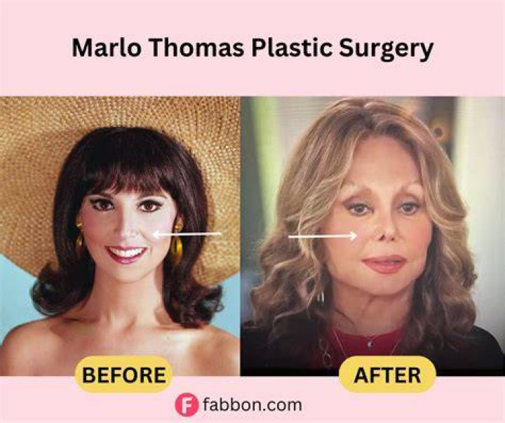 Has Marlo Thomas Had Plastic Surgery? Actress&rsquo; Photos From &lsquo;That Girl