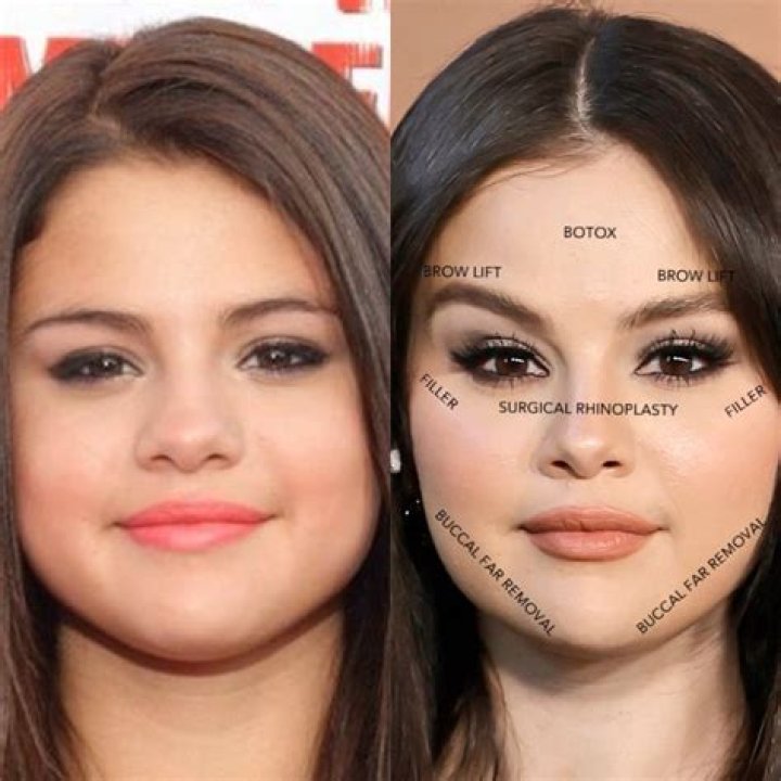 Selena Gomez Plastic Surgery: The Truth Behind the Rumors 1 Selena Gomez Plastic Surgery