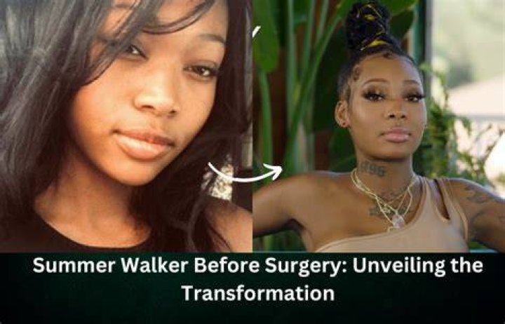 Summer Walker Before Surgery Everything About Explant Surgery