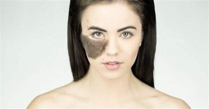 Woman Refuses To Remove Large Birthmark On Her Face, And Her Reason Is